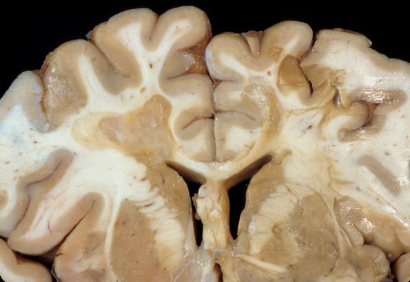 2C2 Multiple Sclerosis, (Case 2) Chronic Active Plaque 2