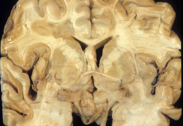 2C4 MS, chronic active (Case 2) A3