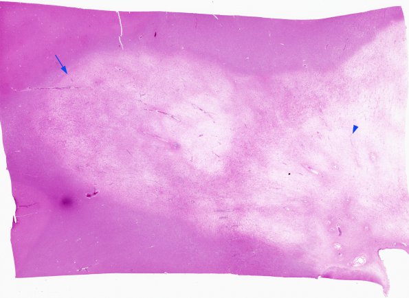 2D1 Multiple Sclerosis, (Case 2) Chronic Active Plaque 1 H&E whole mount 1 copy