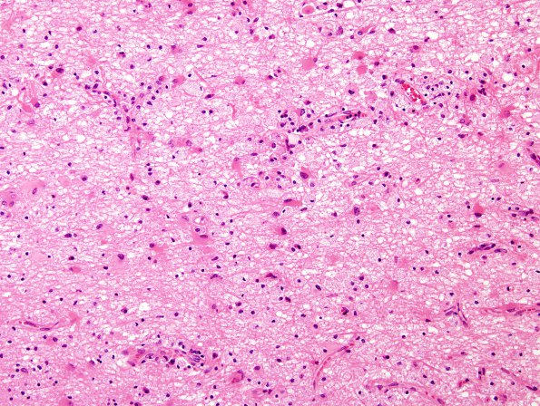 2D5 Multiple Sclerosis (Case 2) Chronic Active Plaque, active area H&E 1 20X