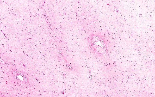 2D6 MS, chronic active (Case 2) N1A Inert area H&E 4X