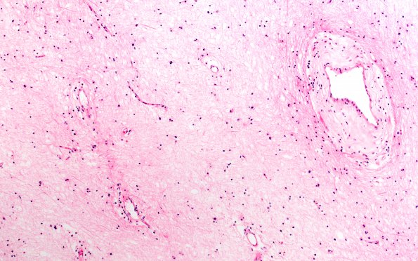 2D7 MS, chronic active (Case 2) N1A Inert area H&E 10X