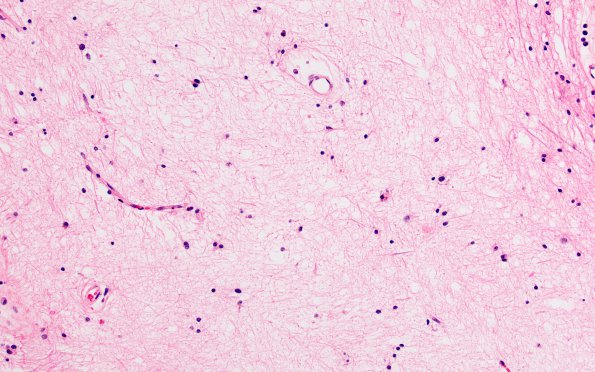 2D8 MS, chronic active (Case 2) N1A Inert area H&E 20XA