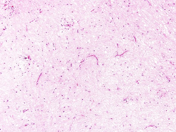 2D9 Multiple Sclerosis (Case 2) Chronic Active Plaque, inactive area H&E 1 10X