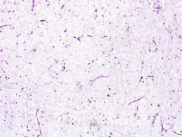 2E10 Multiple Sclerosis (Case 2) Chronic Active Plaque, inactive area LFB-PAS 3 10X