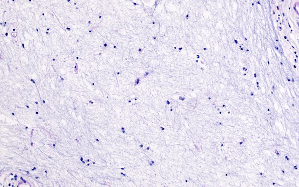 2E11 MS, chronic active (Case 2) N1A Inert area LFB-PAS 20X