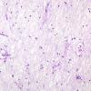 2E12 Multiple Sclerosis (Case 2) Chronic Active Plaque, inactive area LFB-PAS 1 20X