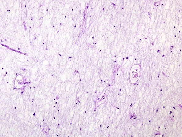 2E12 Multiple Sclerosis (Case 2) Chronic Active Plaque, inactive area LFB-PAS 1 20X