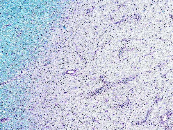 2E3 Multiple Sclerosis (Case 2) Chronic Active Plaque, active area LFB-PAS 2A 10X