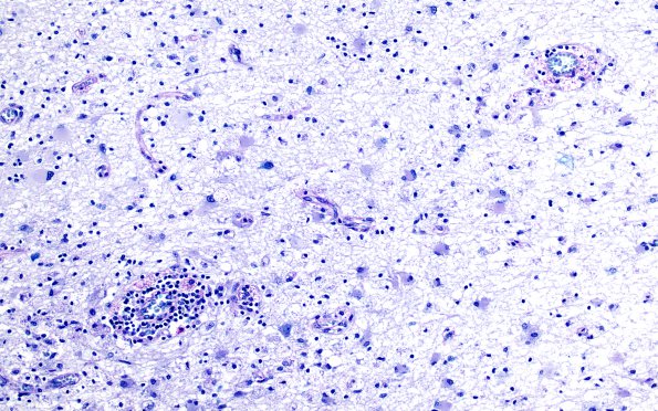 2E5 MS, chronic active (Case 2) N1A Edge LFB-PAS 20X