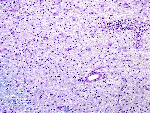 2E6 Multiple Sclerosis (Case 2) Chronic Active Plaque, active area LFB-PAS 1 20X