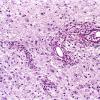 2E7 Multiple Sclerosis (Case 2) Chronic Active Plaque, active area LFB-PAS 1