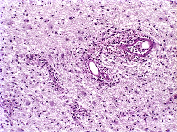 2E7 Multiple Sclerosis (Case 2) Chronic Active Plaque, active area LFB-PAS 1