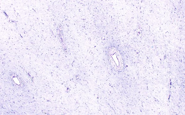 2E8 MS, chronic active (Case 2) N1A Inert area LFB-PAS 4X