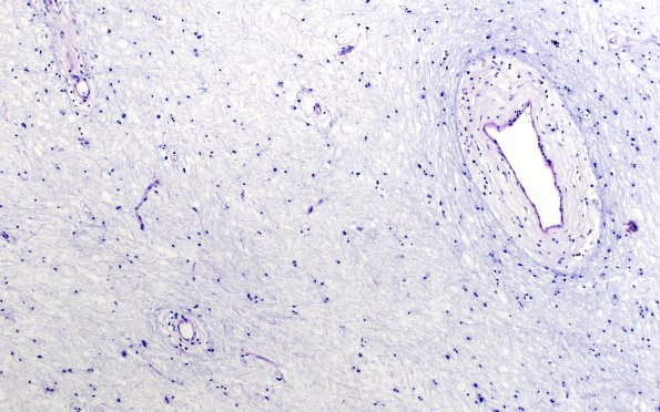 2E9 MS, chronic active (Case 2) N1A Inert area LFB-PAS 10X