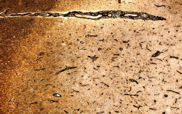 2F2 MS, chronic active (Case 2) N1A Edge Bielschowsky 20X 1