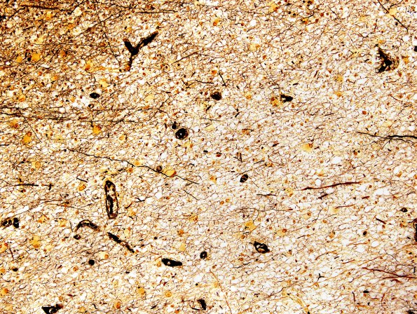 2F4 Multiple Sclerosis (Case 2) Chronic Active Plaque, active area Biels 1