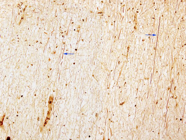 2F7 Multiple Sclerosis (Case 2) Chronic Active Plaque, inactive area) Biels 1 copy