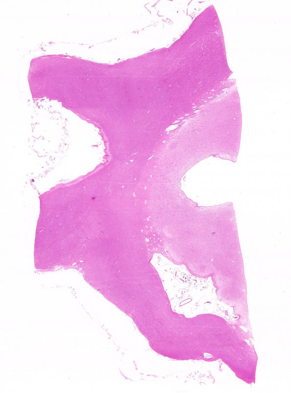 10A Optic nerve-tract (Case 10) H&E WM