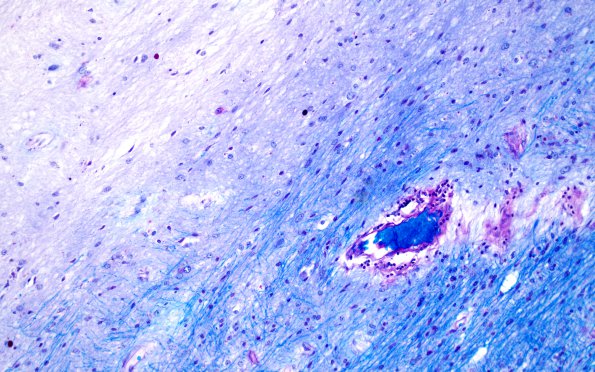10B2 Optic nerve-tract (Case 10) LFB-PAS 20X