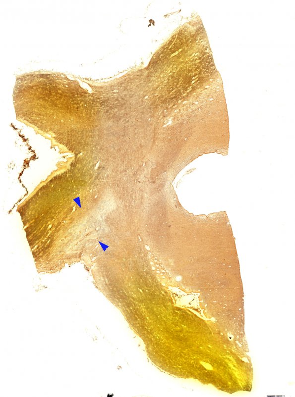 10C1 Optic nerve-tract (Case 10) Bielschowsky WM copy