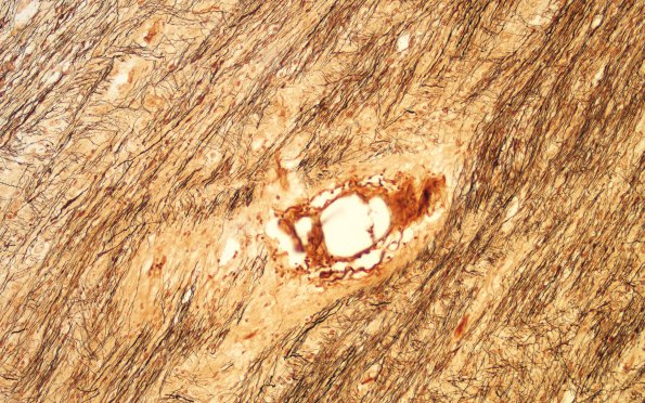 10C2 Optic nerve-tract (Case 10) Bielschowsky 20X