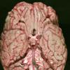 1A1 Multiple Sclerosis (Case 1) _1