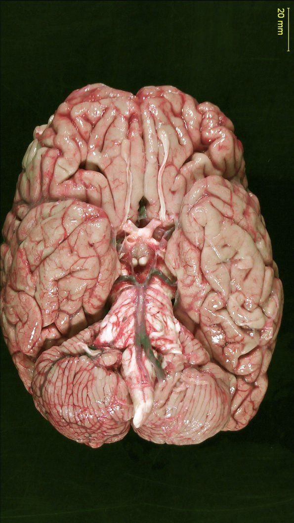 1A1 Multiple Sclerosis (Case 1) _1