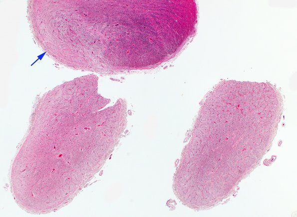 1B1 MS, optic nerve (Case 1) Area A H&E 2X copy