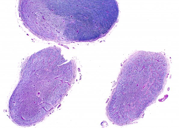 1B2 MS, optic nerve (Case 1) Area A LFB-PAS 2X