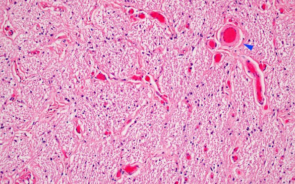 1D1 MS, optic nerve (Case 1) Area B H&E 20X copy