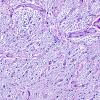 1D2 MS, optic nerve (Case 1) Area B LFB-PAS 20X copy