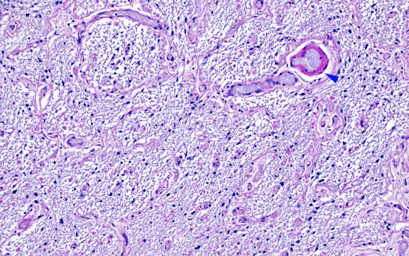 1D2 MS, optic nerve (Case 1) Area B LFB-PAS 20X copy