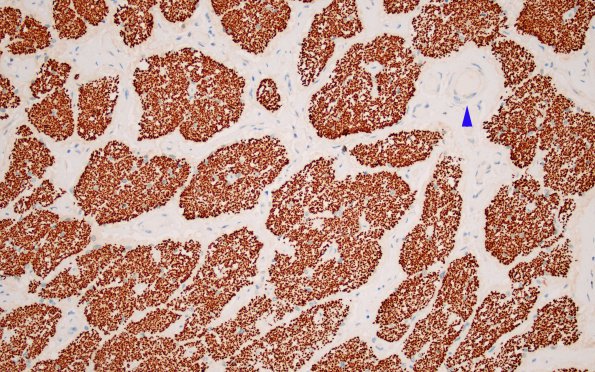 1D3 MS, optic nerve (Case 1) Area B NF 20X copy