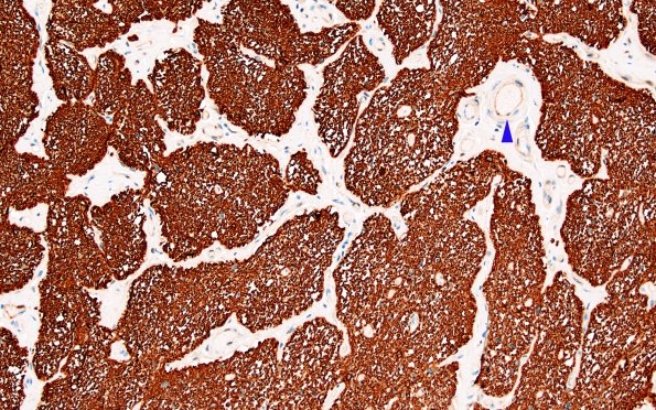 1D4 MS, optic nerve (Case 1) Area B GFAP 10X copy