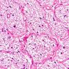 1E1 MS (Case 1) optic nerve H&E 2 40X