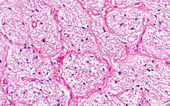 1E1 MS (Case 1) optic nerve H&E 2 40X