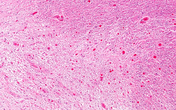 1F1 MS, optic nerve (Case 1) Area C H&E 10X