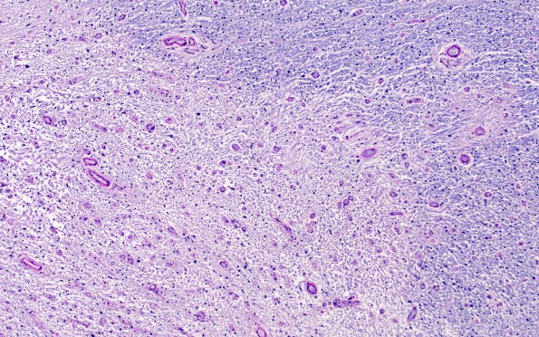 1F2 MS, optic nerve (Case 1) Area C LFB-PAS 10X