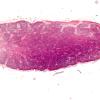 2B1 MS, optic nerve (Case 2) N12 Area B H&E 2X w scale