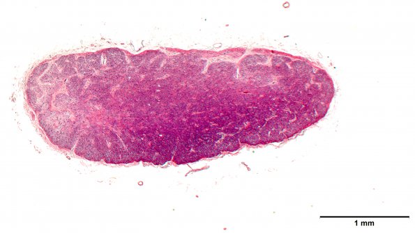 2B1 MS, optic nerve (Case 2) N12 Area B H&E 2X w scale