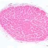 2B2 Normal comparison (Case 2a) optic nerve 2X scale