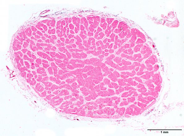 2B2 Normal comparison (Case 2a) optic nerve 2X scale