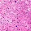 2D1 MS, optic nerve (Case 2) N12 Area B H&E 20X copy