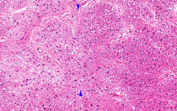 2D1 MS, optic nerve (Case 2) N12 Area B H&E 20X copy