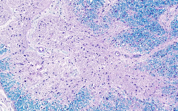 2D2 MS, optic nerve (Case 2) N12 Area B LFB-PAS 20X