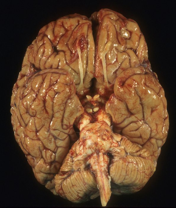 3A1 Multiple Sclerosis (Case 3) 7