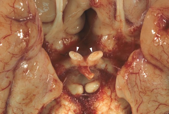 3A2 Multiple Sclerosis (Case 3) 2 copy