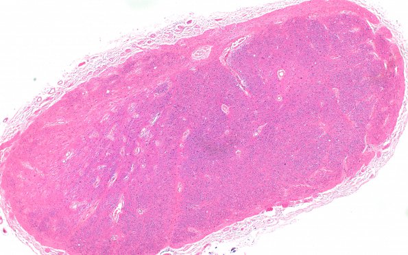 3B1 MS,optic nerve (Case 3) H&E 4X