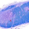 3B2 MS,optic nerve (Case 3) LFB-PAS 4X copy